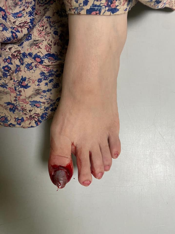 صور صادمة ميار الببلاوي إلى المستشفى مجددا: أصابع القدم تحطمت